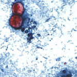 Cyclosporiasis Outbreak Spreads to 45 States With Over 18,000 Cases Confirmed