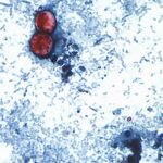 Federal Health Authorities Launch Investigation Into Cyclospora Outbreak Affecting Dozens