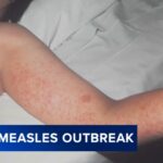 Measles Case Prompts Health Alert at Universal Studios Hollywood Theme Park