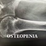 Good Health Report: How expert’s plan worked to reverse bone density loss